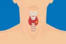 noduli alla tiroide