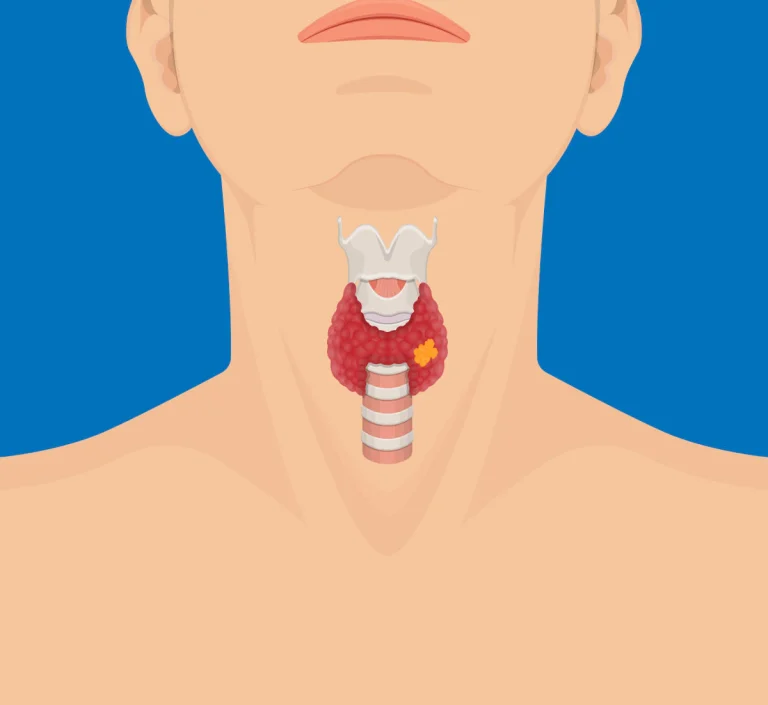 noduli alla tiroide
