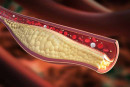 colesterolo LDL statine