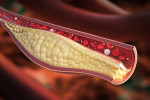 colesterolo LDL statine