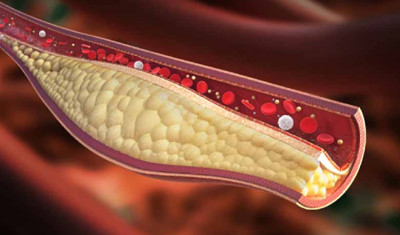 colesterolo LDL statine