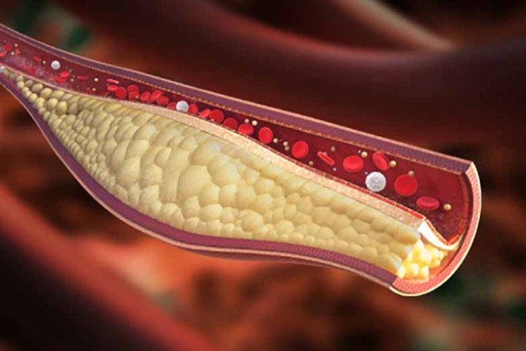 colesterolo LDL statine